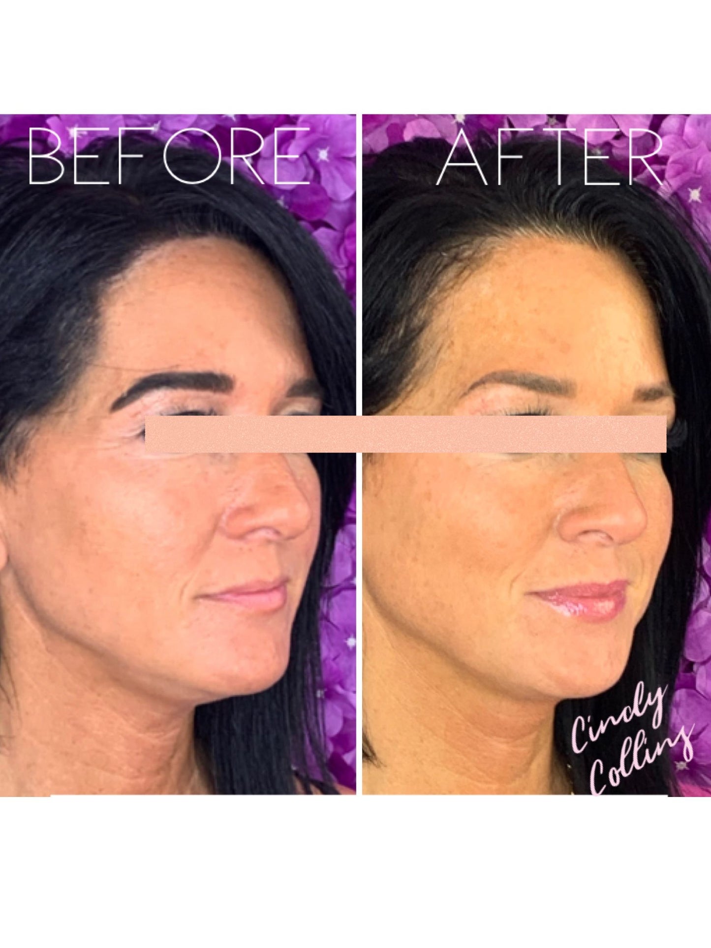Soft Volume Lip Experience (Save $220 + FREE Flawless Gloss)