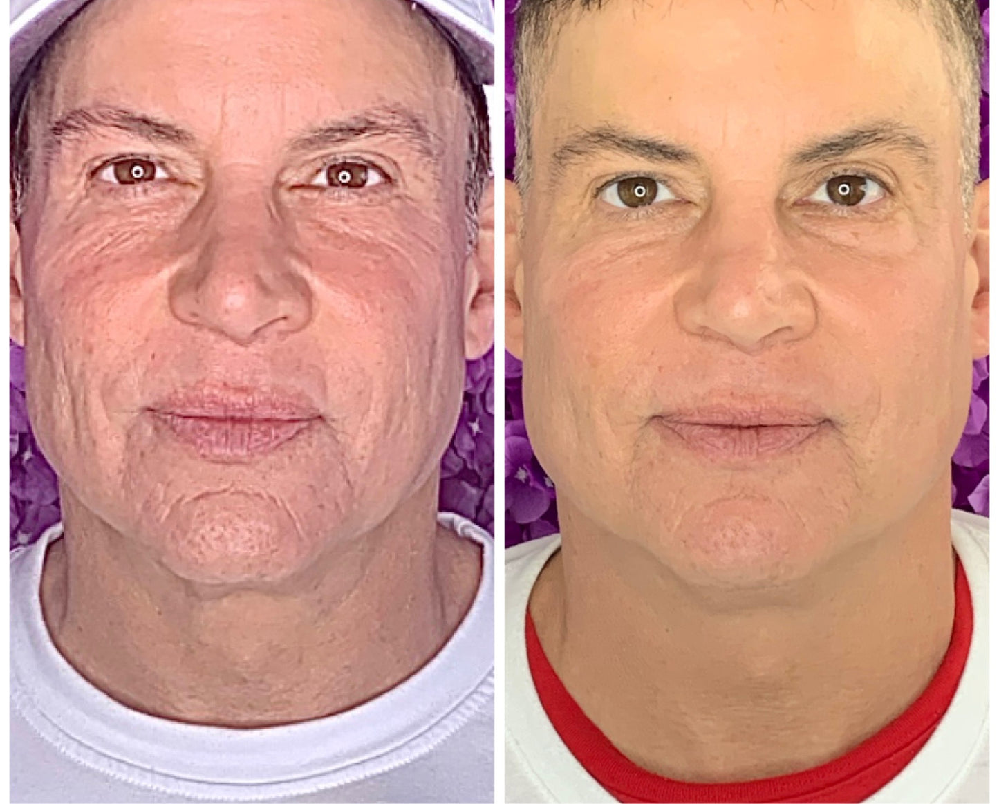 VIP Facial Balancing Package (Save $800 + Free Eyelift)