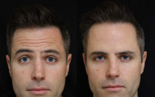 PRIDE "BRO"TOX | 30 UNITS BOTOX | FREE ($225) UNDER EYE TIGHTENING