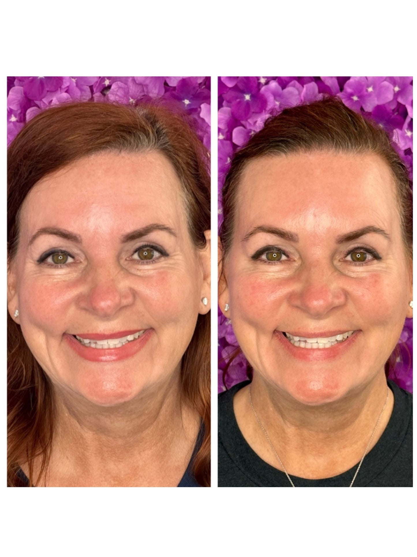 The Upper Face Refresh (Save $375 + Free Lipflip)