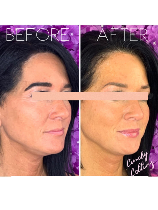 Soft Volume Lip Experience (Save $220 + FREE Flawless Gloss)