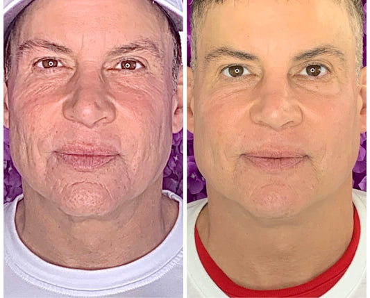 VIP Facial Balancing  Package (Save $800 + Free Eyelift)
