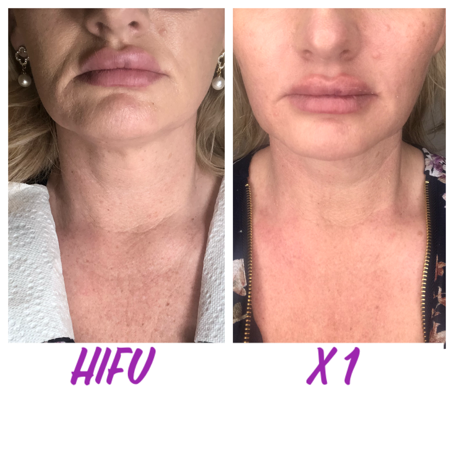 Jawline Revival Series (Save 50%)