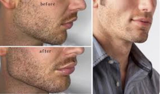 ZADDY LIFT |Masculine Chin Jawline Fillers| 30 units Botox | FREE ($225) Under Eye Tightening 